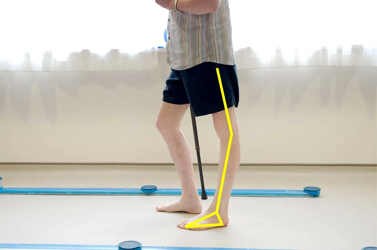 Gait Analysis 1